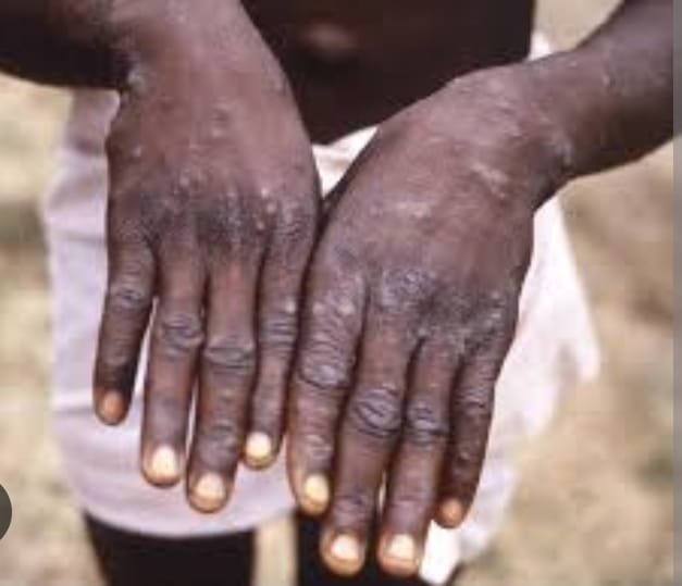 Presque 31.500 cas suspects de mpox recensés en Afrique depuis le début de 2024 | AIB